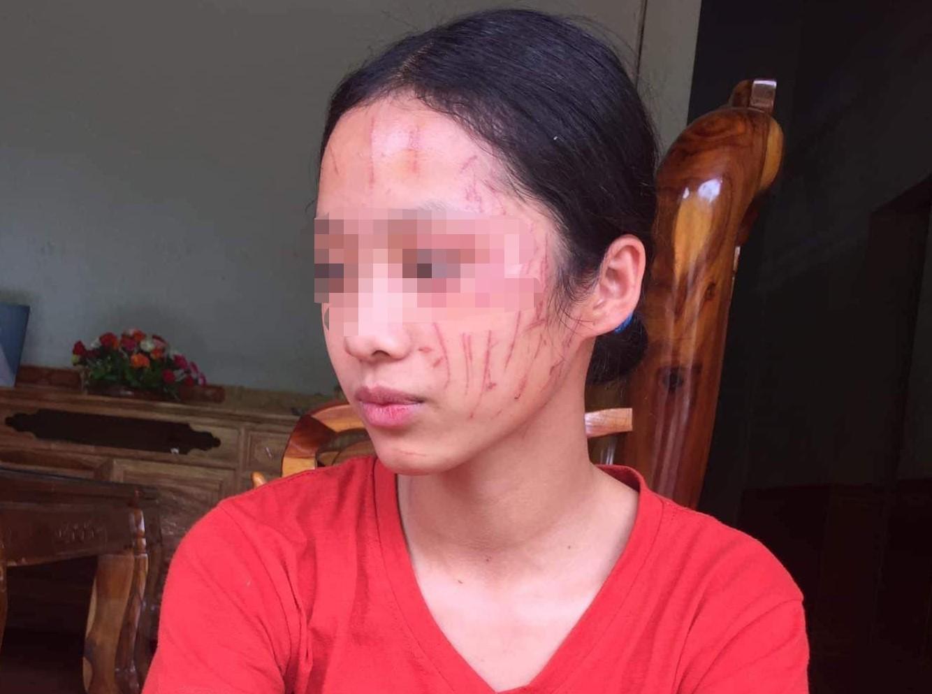 Bênh em gái, nữ sinh lớp 8 bị cào sưng mặt