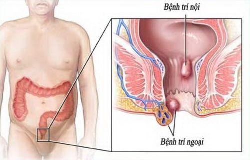 Bệnh trĩ bao gồm (trĩ nội và trĩ ngoại) có thể là yếu tố gây đại tiện ra máu.