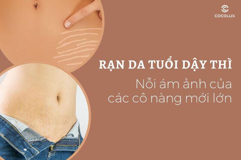 Rạn da tuổi dậy thì - Nỗi ám ảnh của các cô nàng mới lớn
