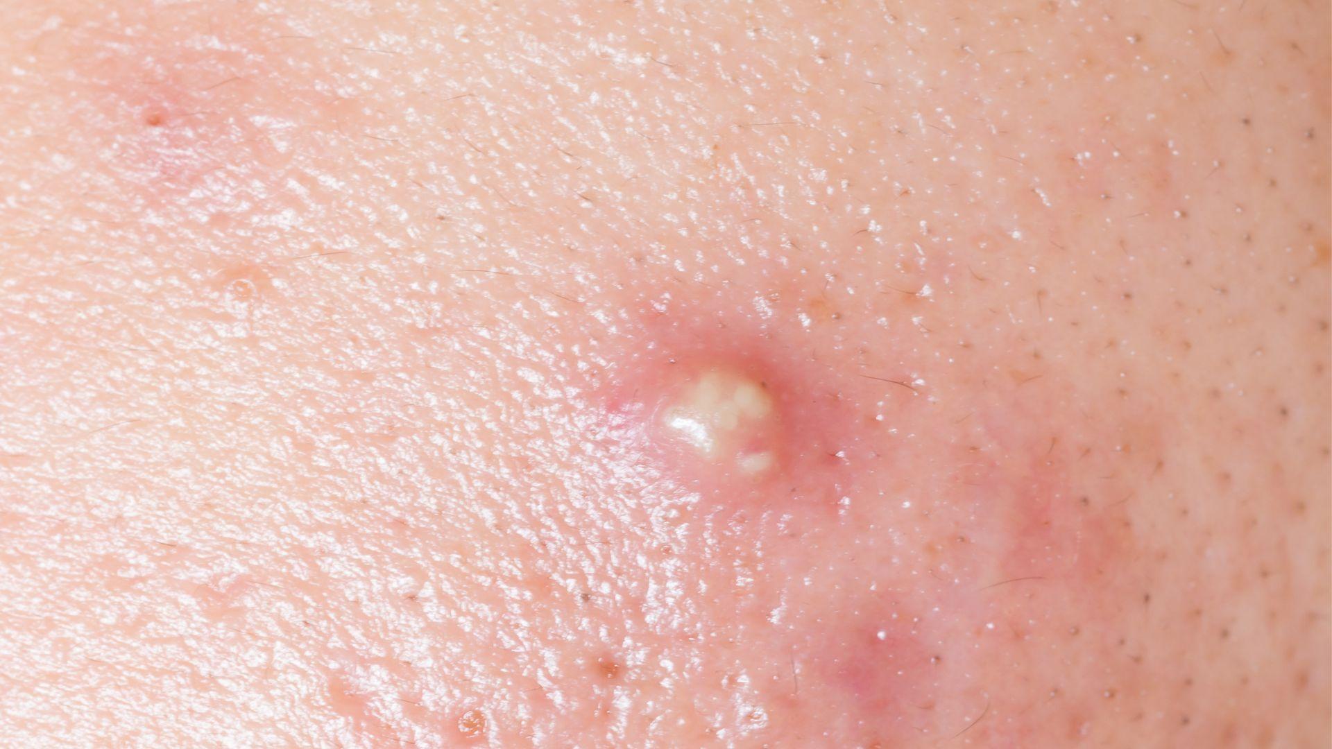 Bị mụn nhọt có nên ăn trứng không? Lợi hay hại cho làn da? 2