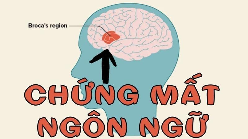 Thất ngôn là gì? Nguyên nhân dẫn đến thất ngôn và phương pháp điều trị