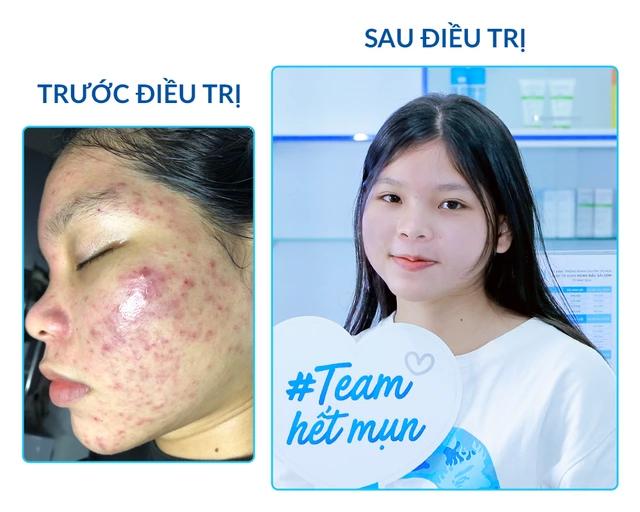 O2 Skin - địa chỉ trị mụn được nhiều bạn trẻ Cần Thơ tin tưởng