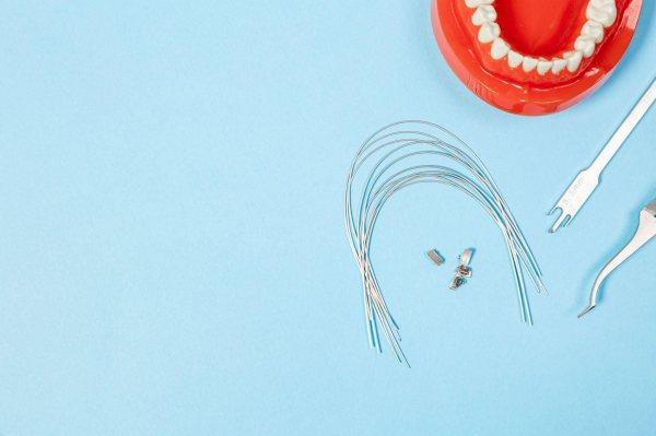 Tất tần tật về dây cung niềng răng – Công dụng và phân loại