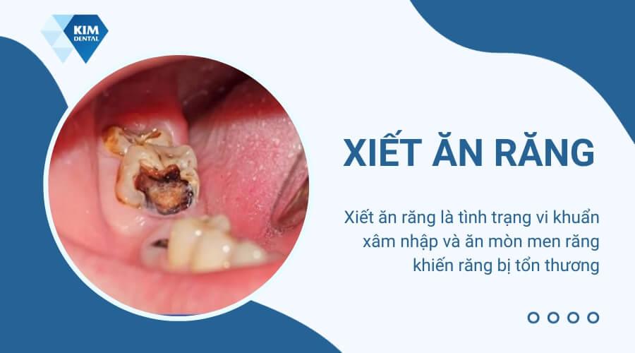 Xiết ăn răng là gì? Cách trị xiết răng ở người lớn và trẻ em