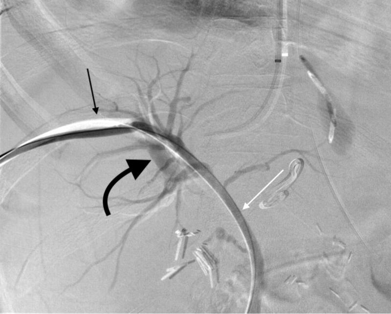 PTBD đường mật​ là gì và một số thông tin cần biết về PTBD đường mật