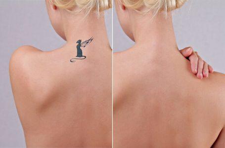 Laser QBeam ND YAG – Xóa xăm tattoo <10cm